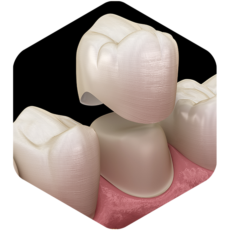Illustration of dental crown